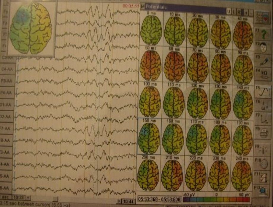 EEG - snimak