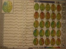 EEG - snimak