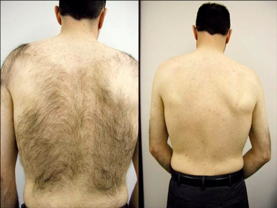 Trajna epilacija - Lumenis Light Sheer Duet laser
