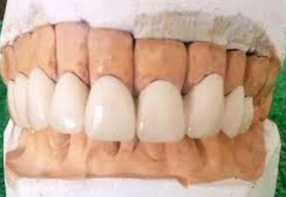 Metalokeramički mostovi EXTRA DENT