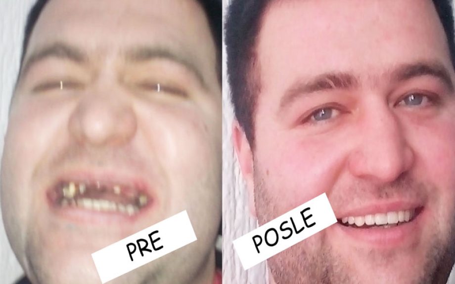 Metalokeramički mostovi