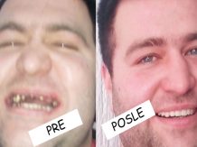 Metalokeramički mostovi