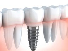 Zubni implantati