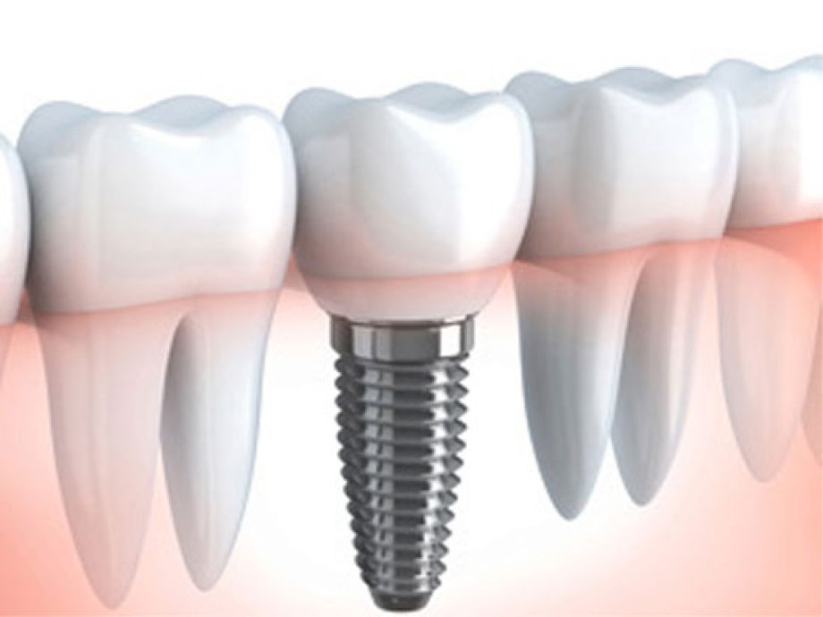 Zubni implantati